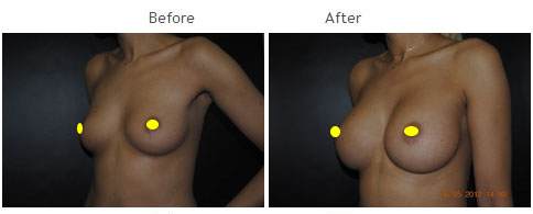 breast augmentation NYC