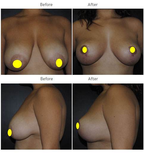 Manhattan Breast Lift NYC