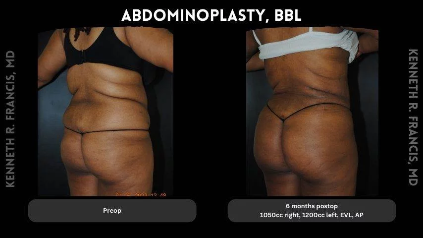 Brazilian Butt Lift Before And After Brazilian Butt Lift Before And After
