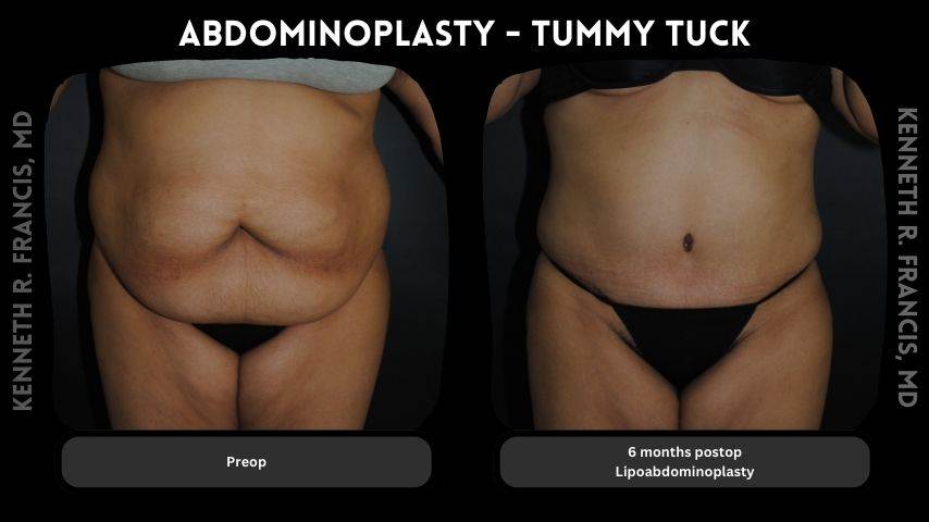 Abdominoplasty - Tummy tuck