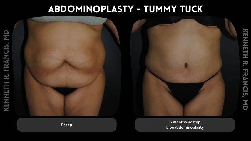 Abdominoplasty - Tummy Tuck