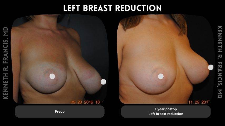Left breast reduction