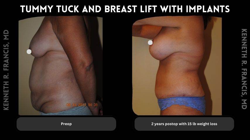 Tummy tuck and breast lift with implants