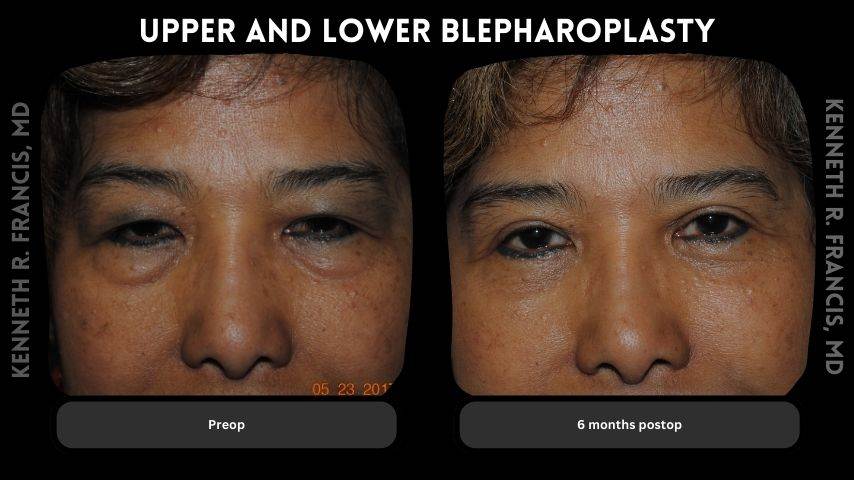 Upper and lower blepharoplasty 1