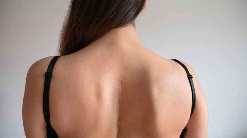 Upper back liposuction NYC 1 Upper back liposuction nyc