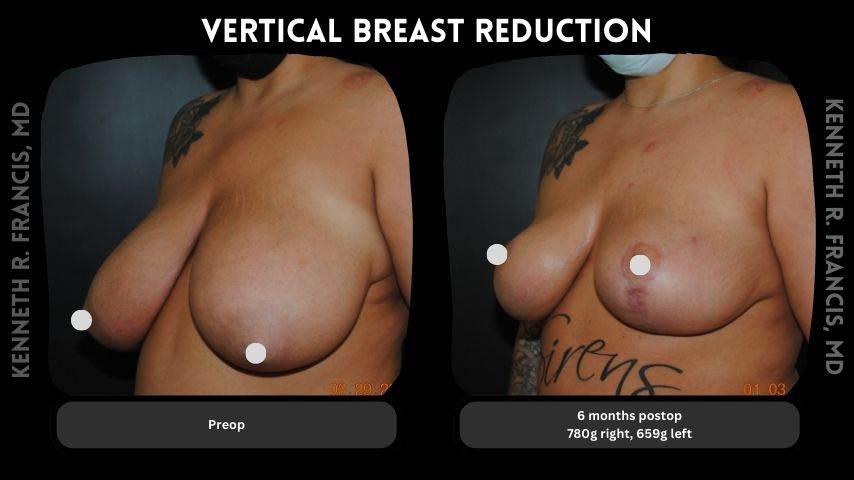 Vertical breast reduction