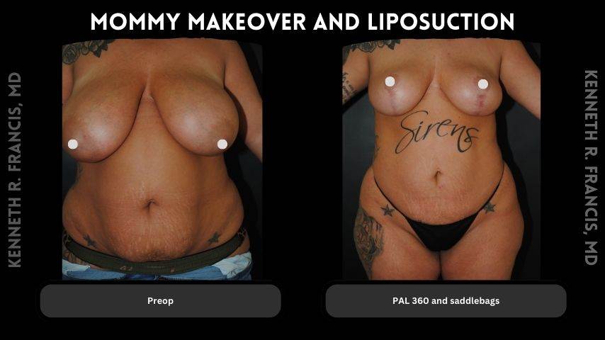 mommy makeover and Liposuction