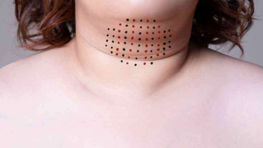 Neck liposuction NYC 1 Neck liposuction nyc