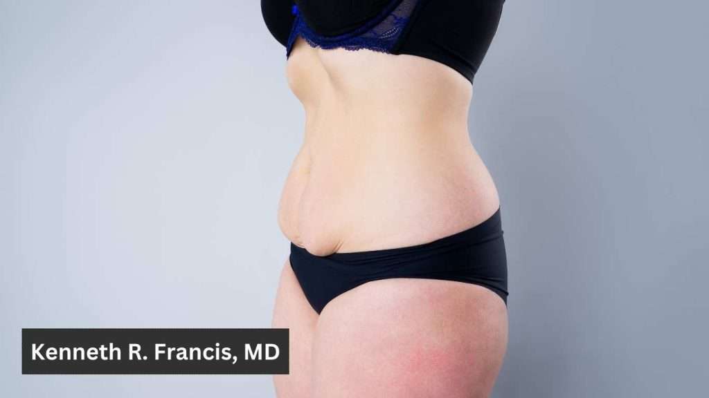 Tummy tuck surgeon in Manhattan 1 Tummy tuck surgeon in Manhattan