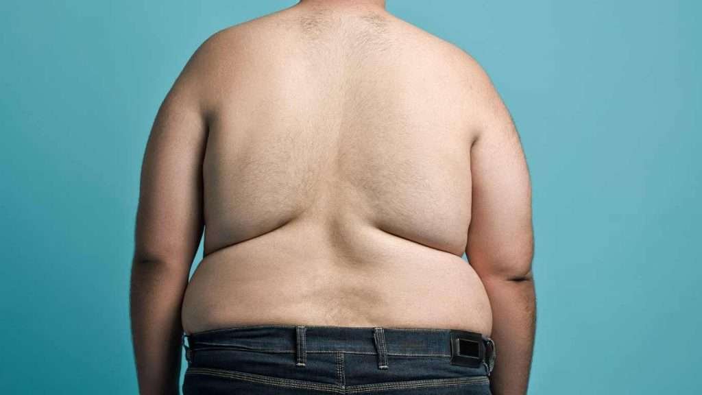 Back Fat Liposuction NYC