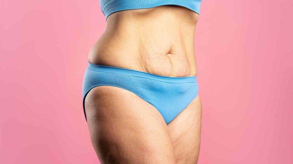 Should I get lipo first then tummy tuck? in New York City