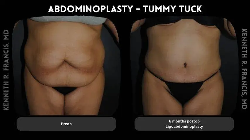 360 tummy tuck before and after in SoHo Manhattan NYC