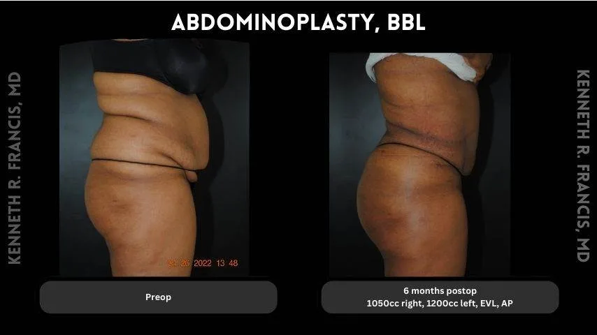 reverse tummy tuck before and after in University Village Manhattan NYC
