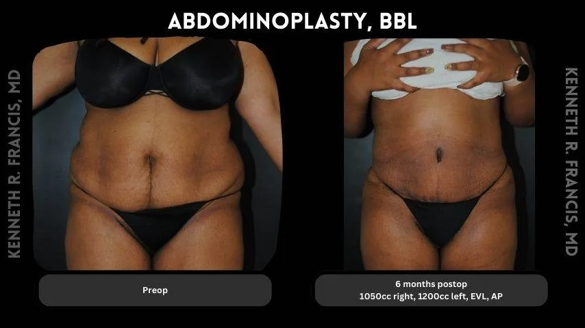 360 tummy tuck before and after in Seneca Village (historical) Manhattan NYC