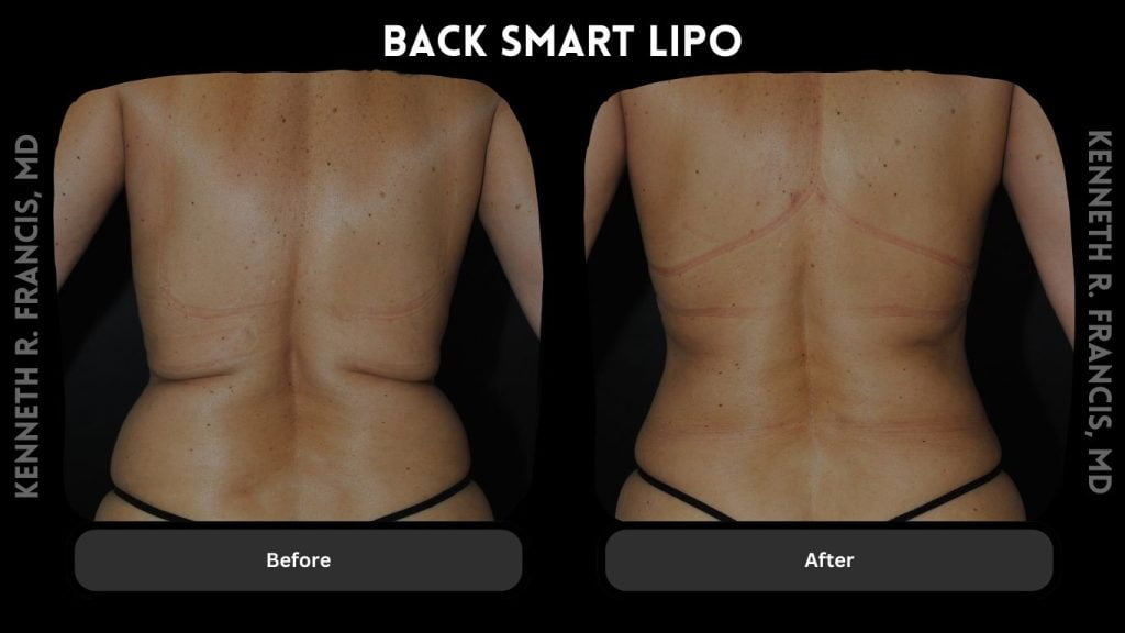 Back Smart Lipo Nyc