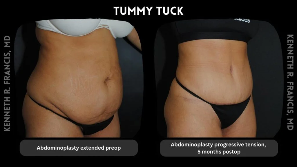 Tummy Tuck Nyc Before And After