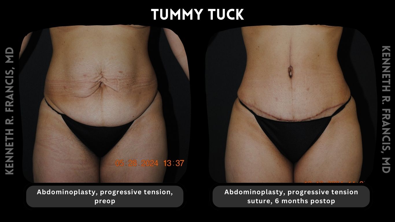 Before and after results of a mini tummy tuck performed by Dr. Francis